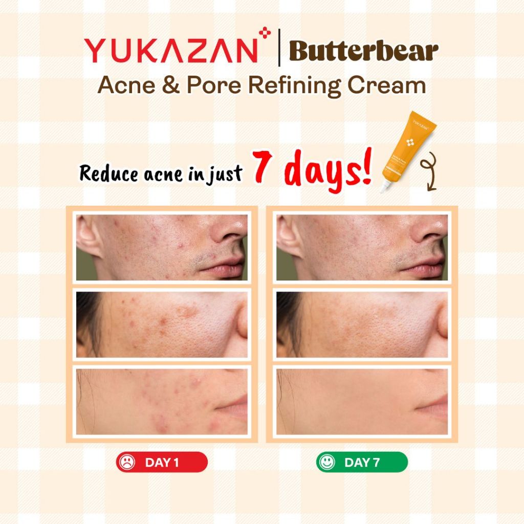 【Yukazan x Butterbear】Yukazan Derma Refining Cream 15ml Acne & Pimple & Pore Care