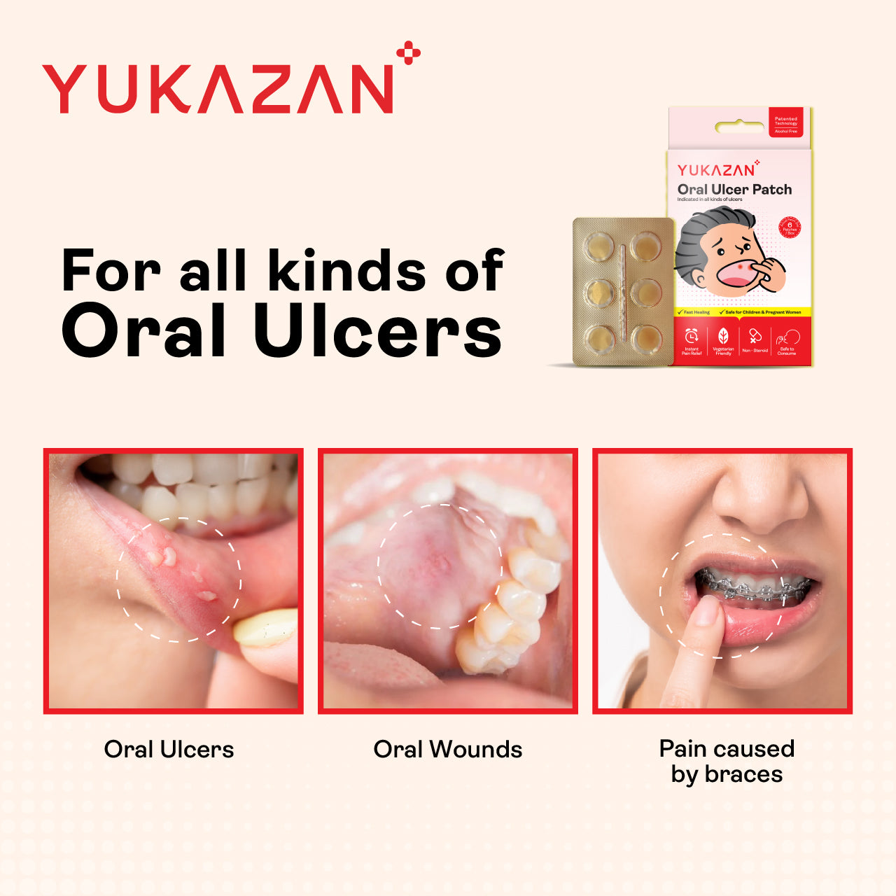 Miếng dán trị loét miệng Yukazan (6 miếng) - Dành cho các loại vết loét miệng &amp; ung thư