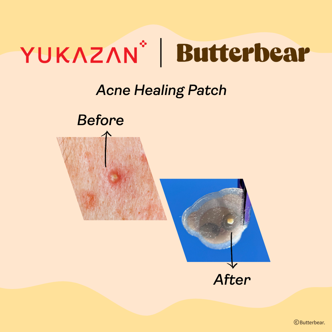 【Yukazan x Butterbear】 Hydrocolloid Acne Healing Patch 20's