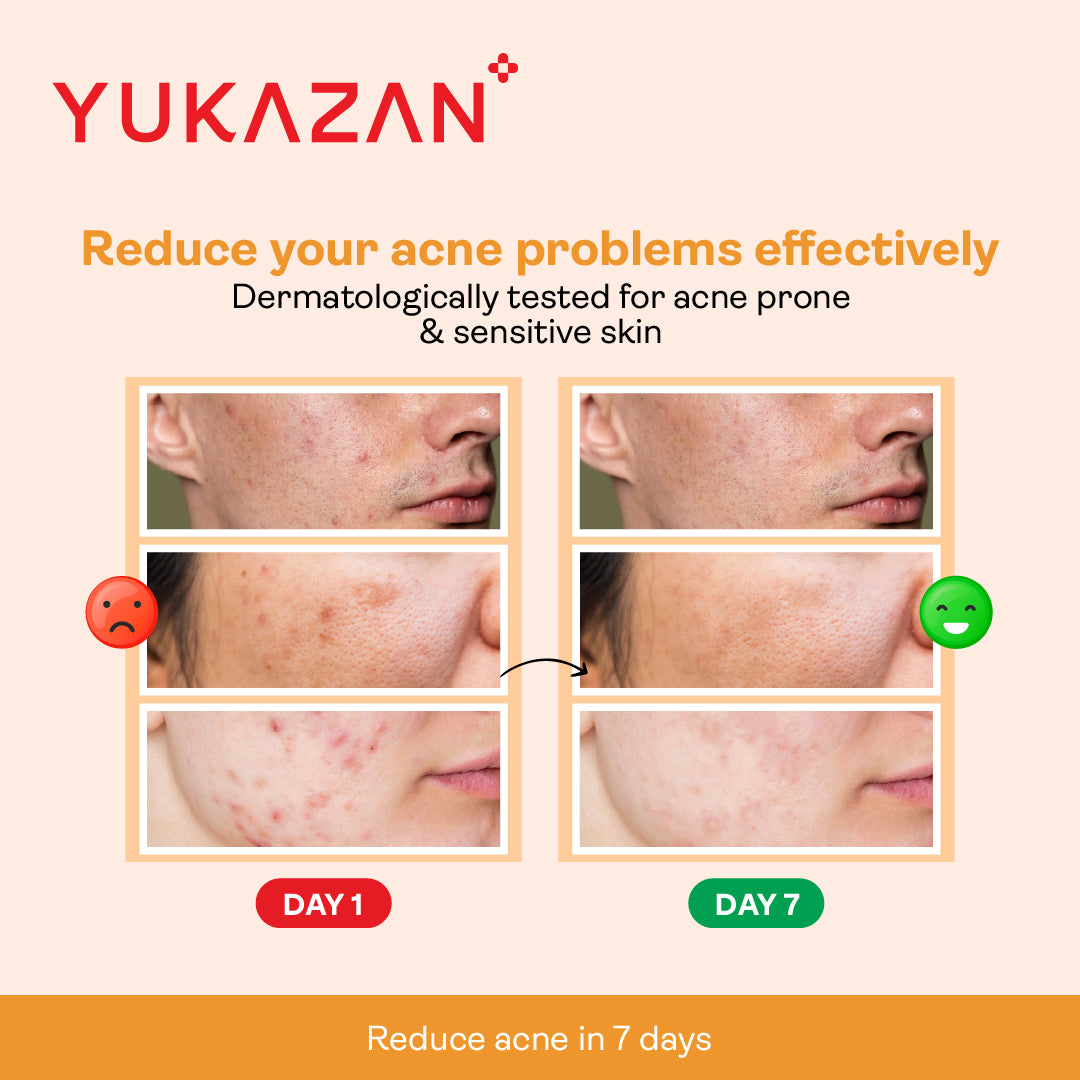 Yukazan Derma Refining Cream Acne & Pore 30ml Acne Removal Cream - Reduce acne in 7 days