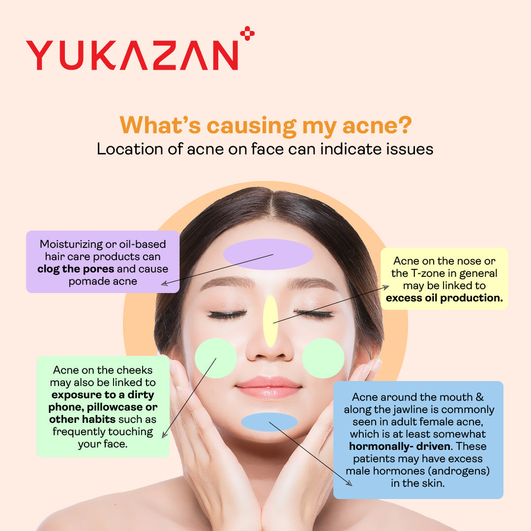 Yukazan Derma Refining Cream Acne &amp; Pore 5ml Kem trị mụn - Giảm mụn sau 7 ngày 